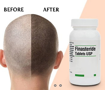 Sochlarim kuzda aqldan ozgandek to'kila boshlaydi, nima bo'lyapti?