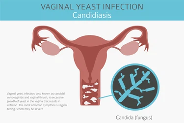 Vaginal Infections Vaginal Infections